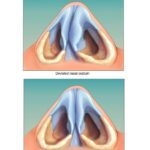 Deviated septum